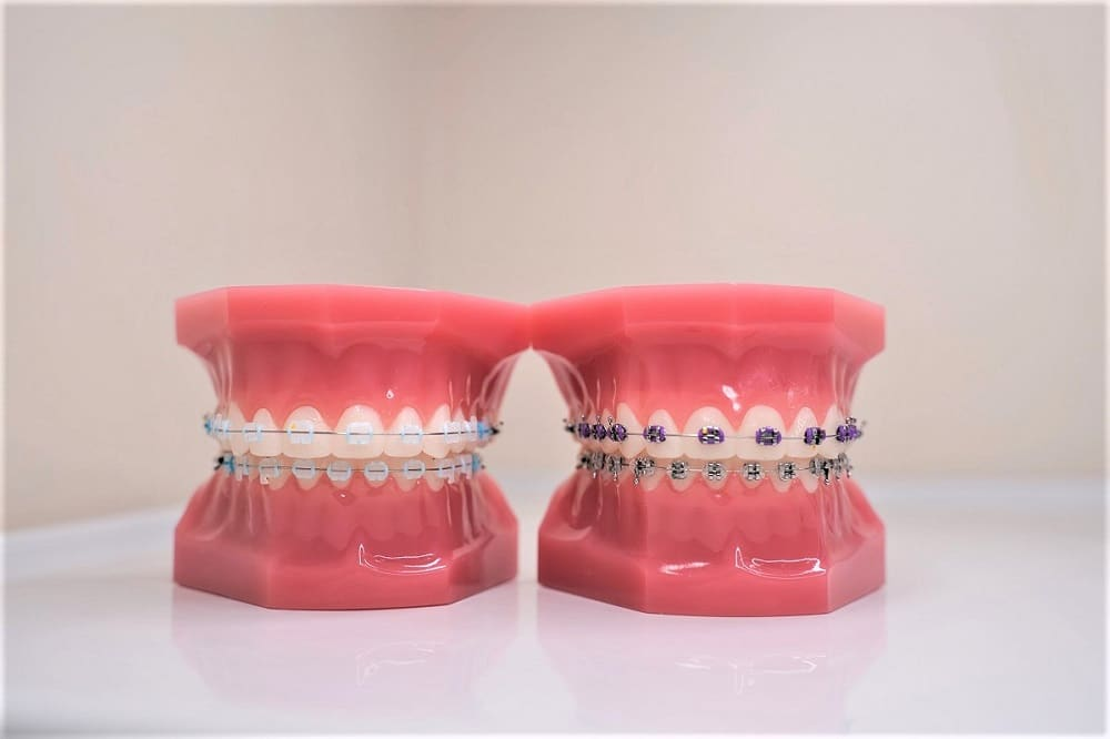 Cost of Braces in Miami: Understanding Treatment Expenses and What Affects Pricing